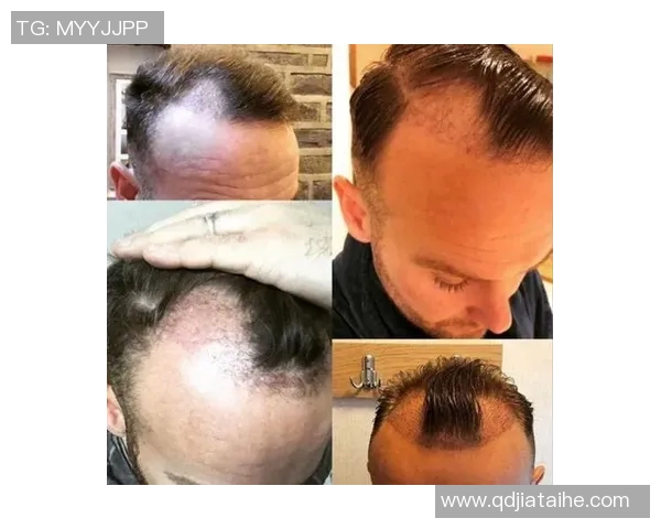 脱发困扰下的足球明星们如何应对发际线后退的烦恼与挑战 脱发困扰下的足球明星们如何应对发际线后退的烦恼与挑战